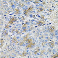 Immunohistochemistry of paraffin-embedded Human liver cancer using SERPINA1 Polyclonal Antibody at dilution of 1:100 (40x lens) .