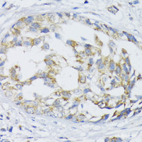 Immunohistochemistry of paraffin-embedded Human mammary cancer using SLC30A1 Polyclonal Antibody at dilution of 1:100 (40x lens) .