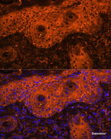 Immunofluorescence analysis of Human skin cancer using TYR Polyclonal Antibody at dilution of 1:100. Blue: DAPI for nuclear staining.