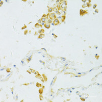 Immunohistochemistry of paraffin-embedded Human lung cancer using SIRT2 Polyclonal Antibody at dilution of 1:100 (40x lens) .