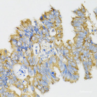 Immunohistochemistry of paraffin-embedded Human rectal cancer using GHRL Polyclonal Antibody at dilution of 1:100 (40x lens) .