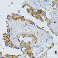 Immunohistochemistry of paraffin-embedded Human lung cancer using ACADL Polyclonal Antibody at dilution of 1:100 (40x lens) .