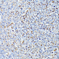Immunohistochemistry of paraffin-embedded Human lymph node tumors using TP53I11 Polyclonal Antibody at dilution of 1:100 (40x lens) .