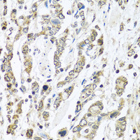 Immunohistochemistry of paraffin-embedded Human gastric cancer using IFNL3 Polyclonal Antibody at dilution of 1:100 (40x lens) .