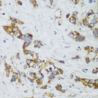 Immunohistochemistry of paraffin-embedded Human gastric cancer using ECH1 Polyclonal Antibody at dilution of 1:150 (40x lens) .