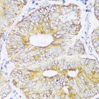 Immunohistochemistry of paraffin-embedded Human colon carcinoma using ECH1 Polyclonal Antibody at dilution of 1:150 (40x lens) .