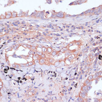 Immunohistochemistry of paraffin-embedded Human lung cancer using RPL32 Polyclonal Antibody at dilution of 1:100 (40x lens) .