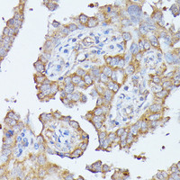 Immunohistochemistry of paraffin-embedded Human lung cancer using HAL Polyclonal Antibody at dilution of 1:100 (40x lens) .