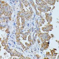 Immunohistochemistry of paraffin-embedded Human thyroid cancer using HAL Polyclonal Antibody at dilution of 1:100 (40x lens) .