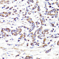 Immunohistochemistry of paraffin-embedded Human gastric cancer using IGF2R Polyclonal Antibody at dilution of 1:100 (40x lens) .