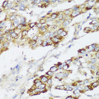 Immunohistochemistry of paraffin-embedded Human liver cancer using ECI2 Polyclonal Antibody at dilution of 1:150 (40x lens) .