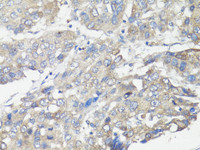 Immunohistochemistry of paraffin-embedded Human liver cancer using MUL1 Polyclonal Antibody at dilution of 1:100 (40x lens) .