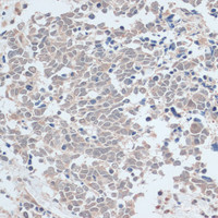 Immunohistochemistry of paraffin-embedded Human lung cancer using ZNF581 Polyclonal Antibody at dilution of 1:100 (40x lens) .