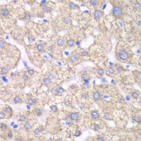 Immunohistochemistry of paraffin-embedded Human liver damage using ACAT1 Polyclonal Antibody at dilution of 1:100 (40x lens) .