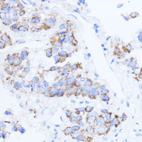 Immunohistochemistry of paraffin-embedded Human liver cancer using ACAT1 Polyclonal Antibody at dilution of 1:100 (40x lens) .