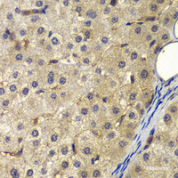 Immunohistochemistry of paraffin-embedded Human liver cancer using AP2A2 Polyclonal Antibody at dilution of 1:200 (40x lens) .