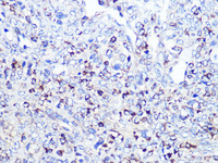 Immunohistochemistry of paraffin-embedded Human oophoroma using CD68 Polyclonal Antibody at dilution of 1:100 (40x lens) .