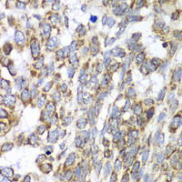 Immunohistochemistry of paraffin-embedded Human esophageal cancer using DLST Polyclonal Antibody at dilution of 1:100 (40x lens) .