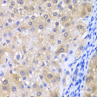 Immunohistochemistry of paraffin-embedded Human liver damage using GPX4 Polyclonal Antibody at dilution of 1:200 (40x lens) .