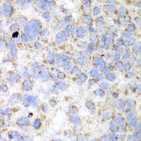 Immunohistochemistry of paraffin-embedded Human esophageal cancer using HADHA Polyclonal Antibody at dilution of 1:100 (40x lens) .