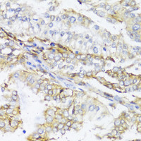 Immunohistochemistry of paraffin-embedded Human colon carcinoma using HLA-DPB1 Polyclonal Antibody at dilution of 1:100 (40x lens) .