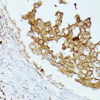Immunohistochemistry of paraffin-embedded Human breast cancer using CD168 Polyclonal Antibody at dilution of 1:100 (40x lens) .