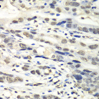 Immunohistochemistry of paraffin-embedded Human gastric cancer using NUDT1 Polyclonal Antibody at dilution of 1:100 (40x lens) .