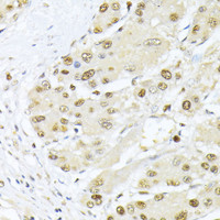 Immunohistochemistry of paraffin-embedded Human liver cancer using PCNA Polyclonal Antibody at dilution of 1:100 (40x lens) .