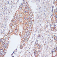 Immunohistochemistry of paraffin-embedded Human colon cancer using MBTPS1 Polyclonal Antibody at dilution of 1:100 (40x lens) .