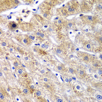 Immunohistochemistry of paraffin-embedded Human liver damage using DPP3 Polyclonal Antibody at dilution of 1:100 (40x lens) .