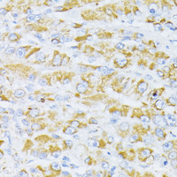 Immunohistochemistry of paraffin-embedded Human liver cancer using Cytochrome c Polyclonal Antibody at dilution of 1:100 (40x lens) .