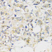 Immunohistochemistry of paraffin-embedded Human breast cancer using MLKL Polyclonal Antibody at dilution of 1:100 (40x lens) .
