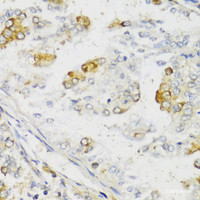 Immunohistochemistry of paraffin-embedded Human uterine cancer using MLKL Polyclonal Antibody at dilution of 1:100 (40x lens) .