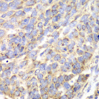 Immunohistochemistry of paraffin-embedded Human esophageal cancer using ACY1 Polyclonal Antibody at dilution of 1:100 (40x lens) .