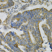 Immunohistochemistry of paraffin-embedded Human colon carcinoma using AK1 Polyclonal Antibody at dilution of 1:100 (40x lens) .