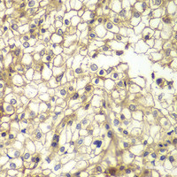 Immunohistochemistry of paraffin-embedded Human kidney cancer using CD1D Polyclonal Antibody at dilution of 1:200 (40x lens) .