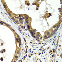 Immunohistochemistry of paraffin-embedded Human gastric cancer using CTSS Polyclonal Antibody at dilution of 1:200 (40x lens) .