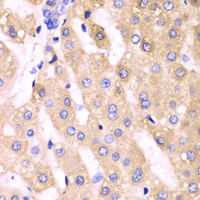 Immunohistochemistry of paraffin-embedded Human liver cancer using CYP3A4 Polyclonal Antibody at dilution of 1:100 (40x lens) .