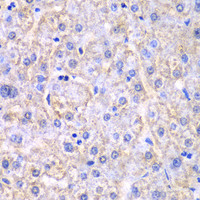Immunohistochemistry of paraffin-embedded Human liver damage using EHHADH Polyclonal Antibody at dilution of 1:100 (40x lens) .