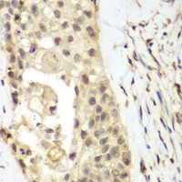 Immunohistochemistry of paraffin-embedded Human lung cancer using FGFR1 Polyclonal Antibody at dilution of 1:100 (40x lens) .