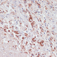 Immunohistochemistry of paraffin-embedded Human liver cancer using LYZ Polyclonal Antibody at dilution of 1:100 (40x lens) .