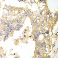Immunohistochemistry of paraffin-embedded Human liver cancer using PYGB Polyclonal Antibody at dilution of 1:100 (40x lens) .