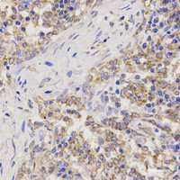 Immunohistochemistry of paraffin-embedded Human lung cancer using TNFRSF1B Polyclonal Antibody at dilution of 1:200 (40x lens) .