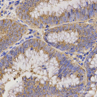 Immunohistochemistry of paraffin-embedded Human rectal cancer using TNFRSF1B Polyclonal Antibody at dilution of 1:200 (40x lens) .