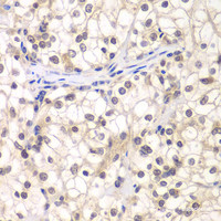 Immunohistochemistry of paraffin-embedded Human kidney cancer using USF1 Polyclonal Antibody at dilution of 1:200 (40x lens) .