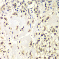 Immunohistochemistry of paraffin-embedded Human kidney cancer using HAUSP / USP7 Polyclonal Antibody at dilution of 1:200 (40x lens) .