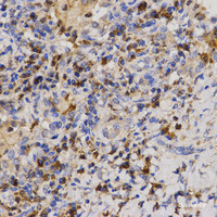 Immunohistochemistry of paraffin-embedded Human lung cancer using Eif2ak2 Polyclonal Antibody at dilution of 1:200 (40x lens) .
