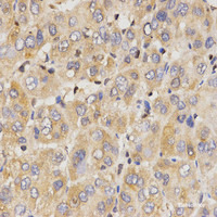 Immunohistochemistry of paraffin-embedded Human liver cancer using Eif2ak2 Polyclonal Antibody at dilution of 1:200 (40x lens) .