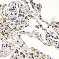 Immunohistochemistry of paraffin-embedded Human lung cancer using WNT3A Polyclonal Antibody at dilution of 1:200 (40x lens) .