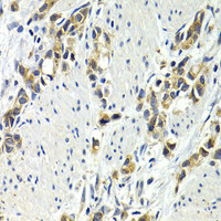 Immunohistochemistry of paraffin-embedded Human gastric cancer using WNT3A Polyclonal Antibody at dilution of 1:200 (40x lens) .